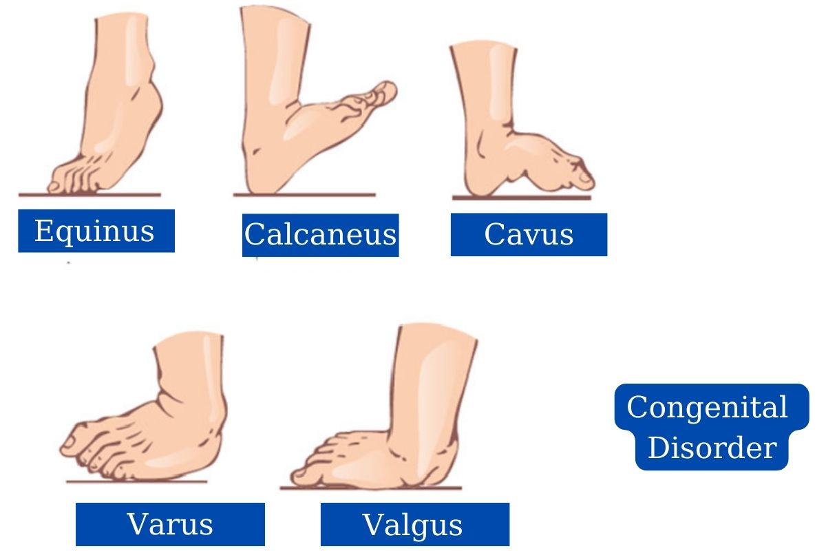 congenital disorder feet